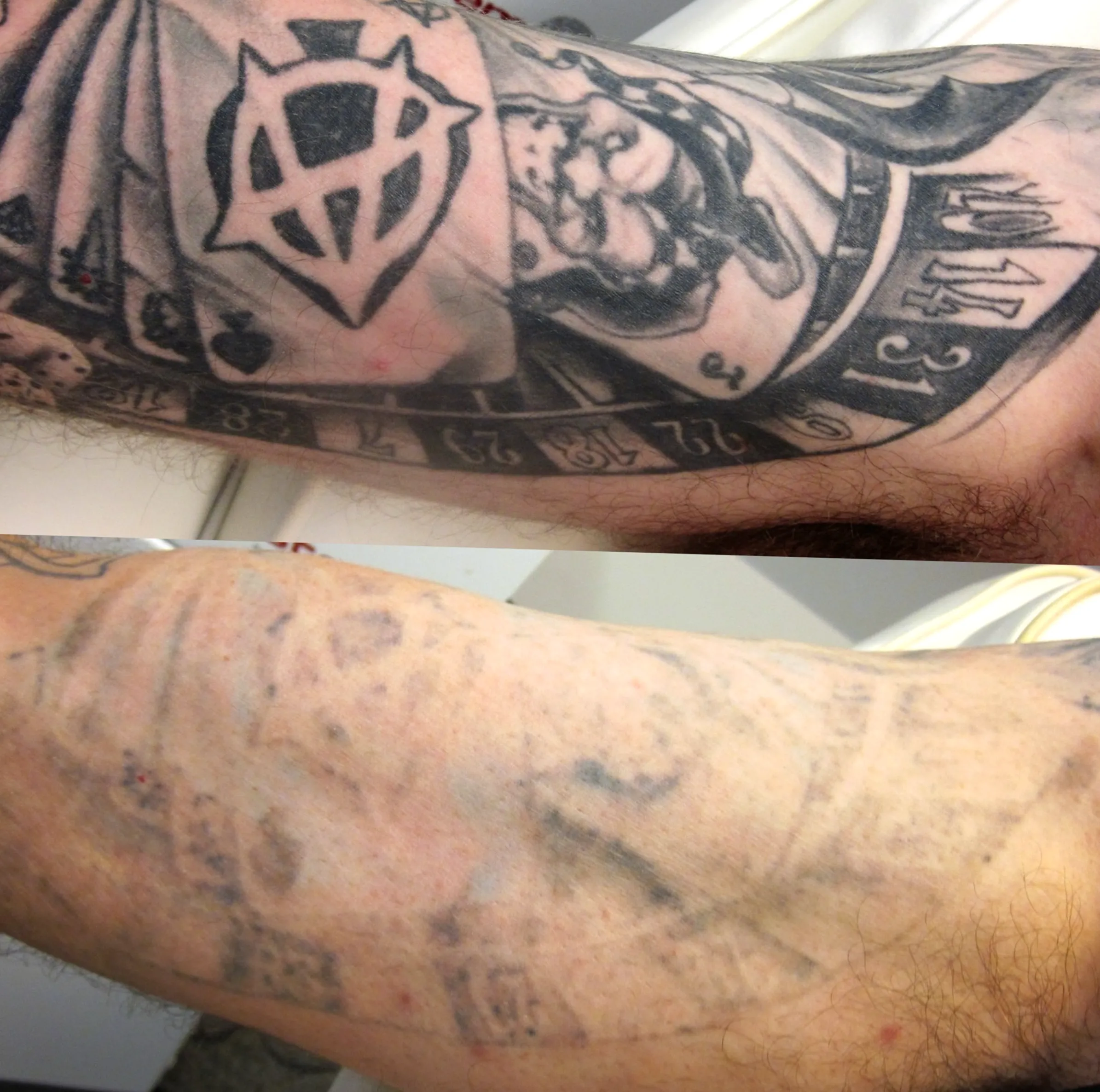 tattoo removal risks
