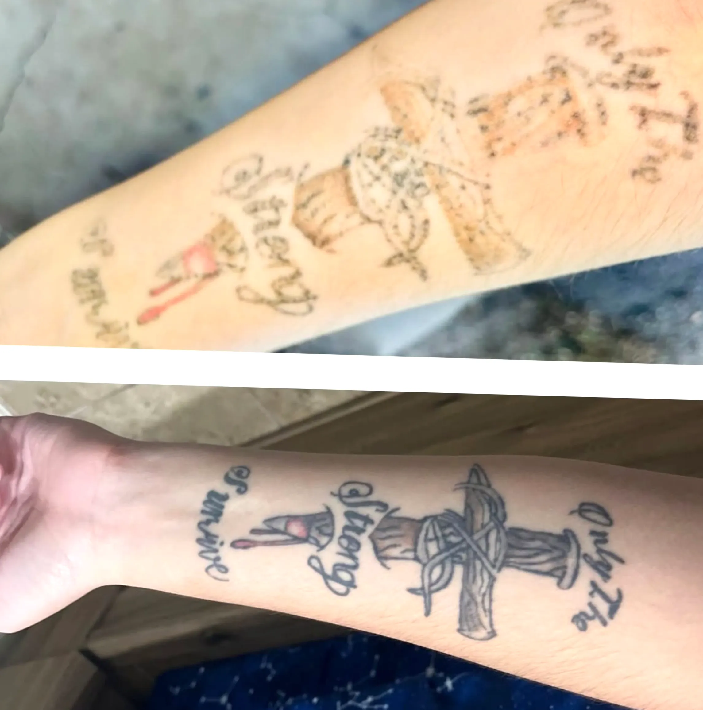 saline tattoo removal