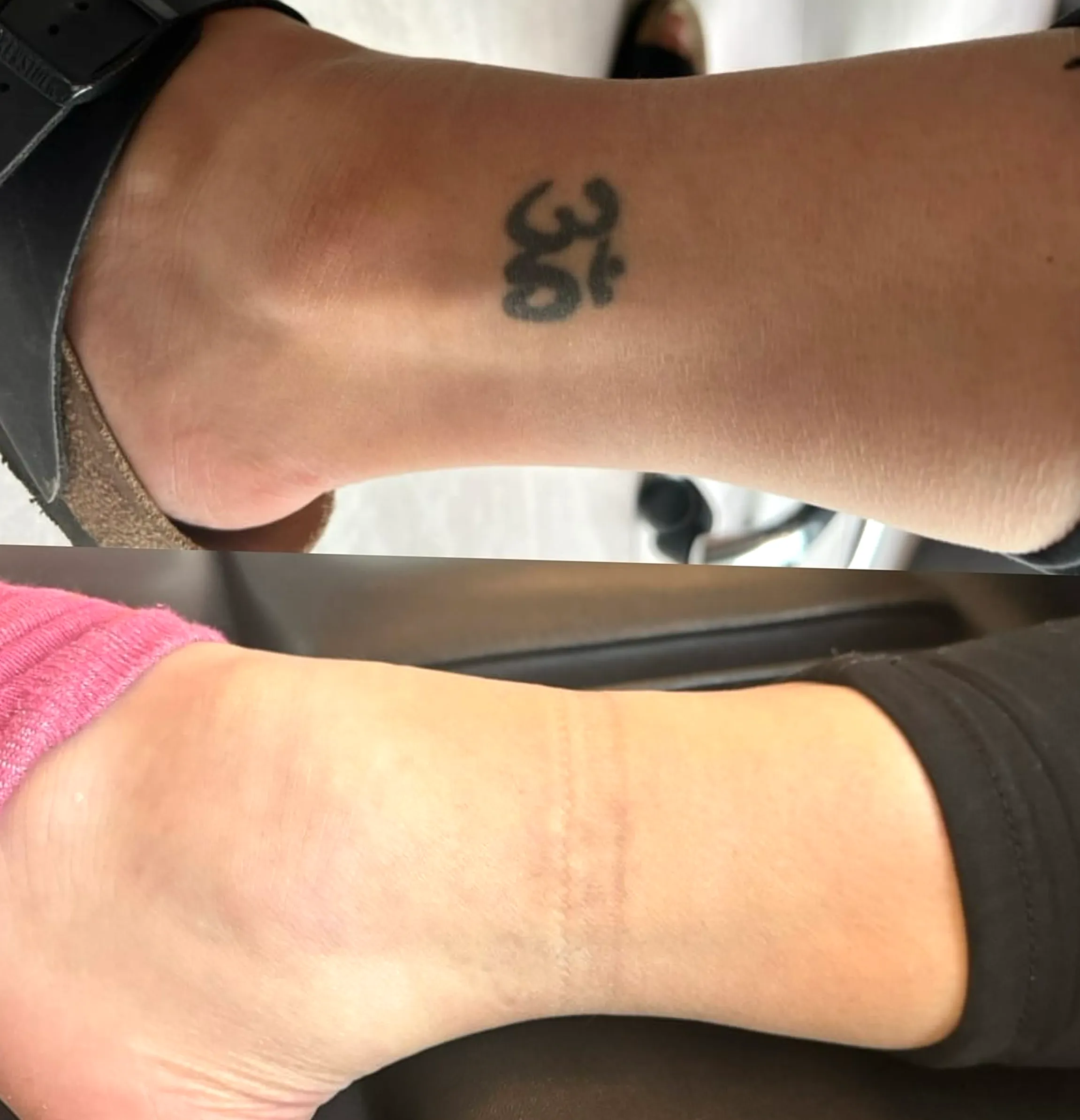 laser tattoo removal Melbourne