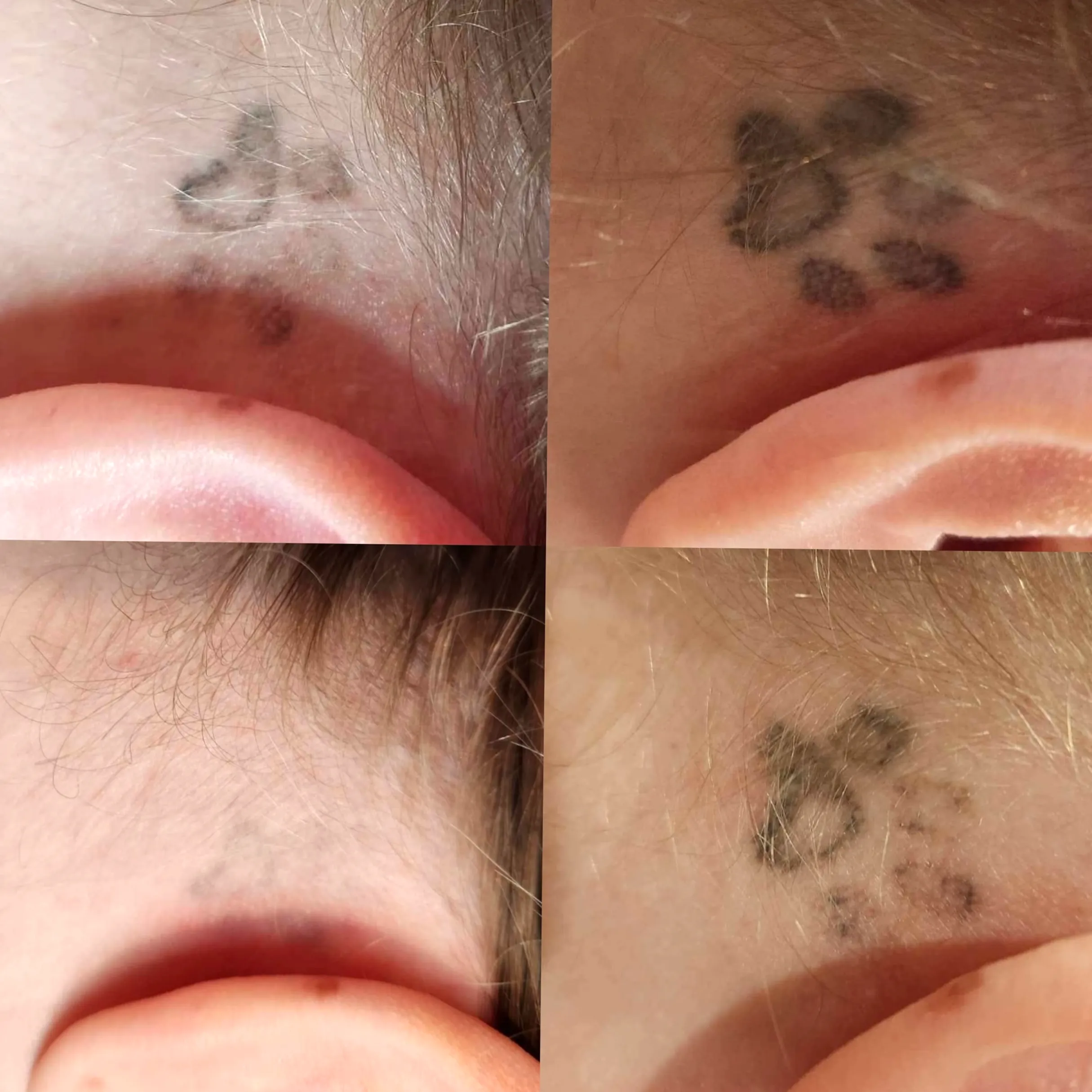 safe tattoo removal methods