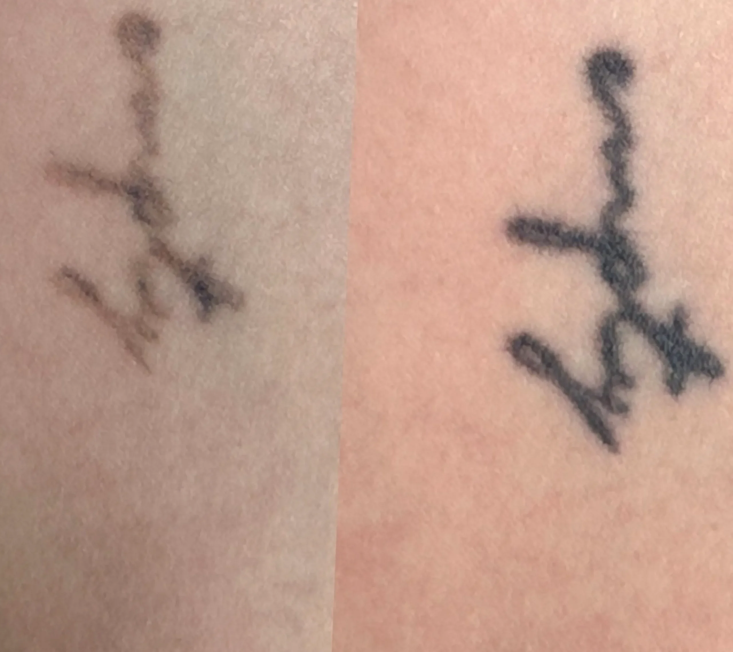 candle wax tattoo removal